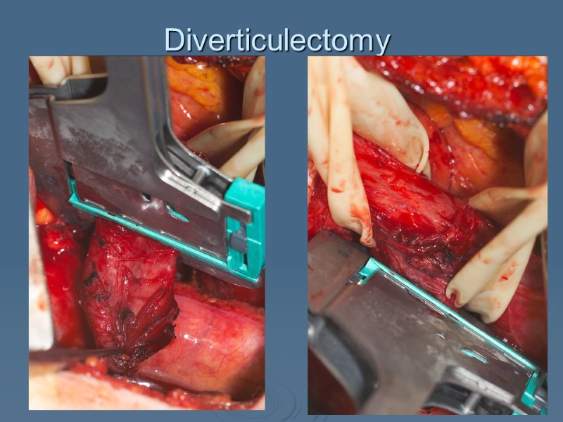 Diverticulectomy